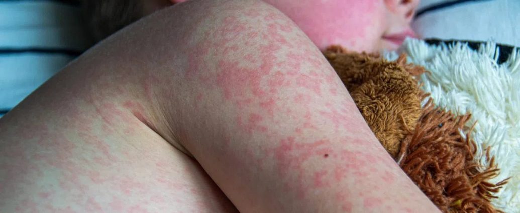 Alberta measles outbreak - Healthcare worker preparing measles vaccine injection at Alberta clinic