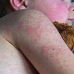 Alberta measles outbreak - Healthcare worker preparing measles vaccine injection at Alberta clinic