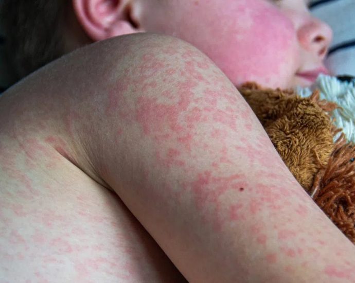 Alberta measles outbreak - Healthcare worker preparing measles vaccine injection at Alberta clinic