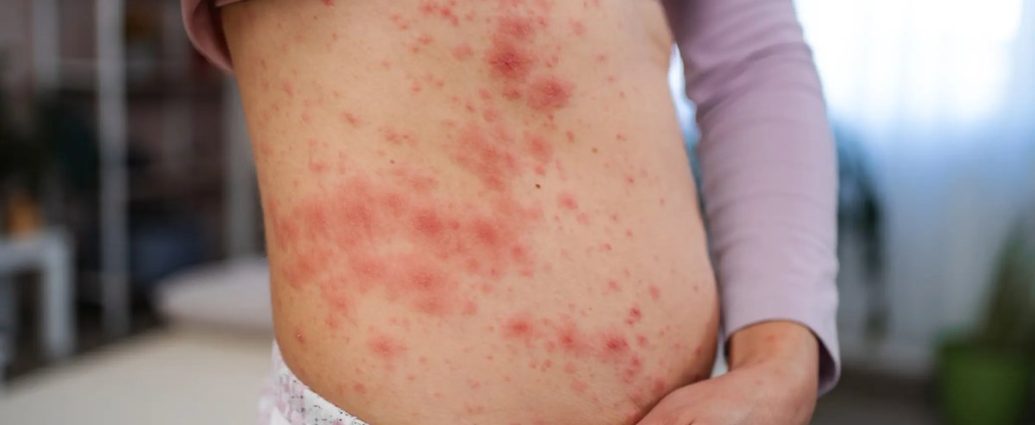 measles exposure GTA - Public transit bus representing measles exposure warning for GTA commuters