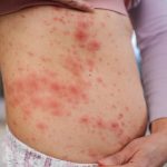 measles exposure GTA - Public transit bus representing measles exposure warning for GTA commuters