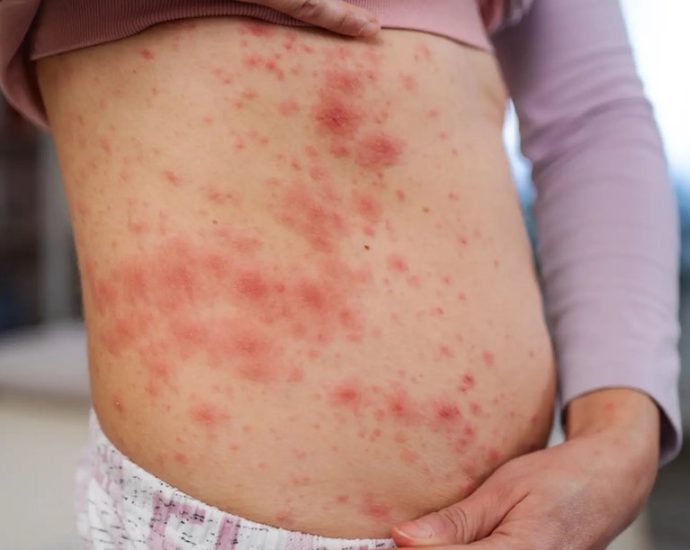 measles exposure GTA - Public transit bus representing measles exposure warning for GTA commuters