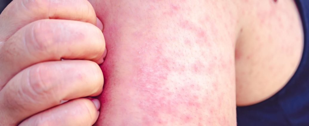 measles exposure York Region - Medical professional preparing measles vaccine injection