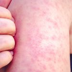 measles exposure York Region - Medical professional preparing measles vaccine injection
