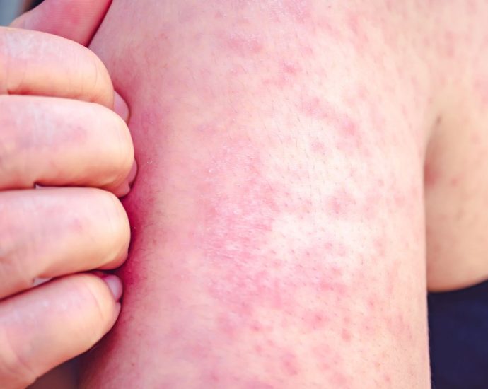 measles exposure York Region - Medical professional preparing measles vaccine injection